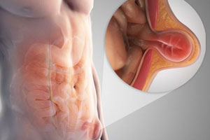 Best Hernia Treatment & Surgery in Pune