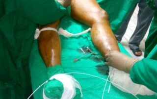 Hernia Treatment in Pune