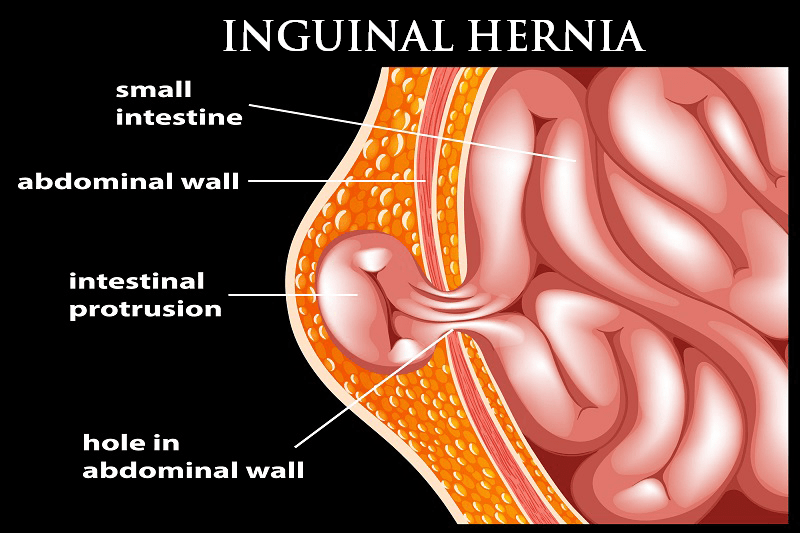 Inguinal hernia surgeon in Pune