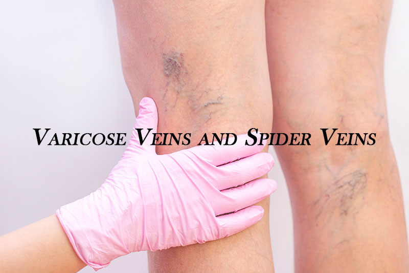 Varicose Veins Treatment in Hadapsar, Pune