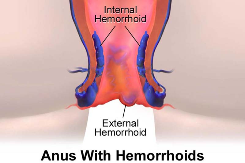 hemorrhoids laser surgery cost in hadapsar