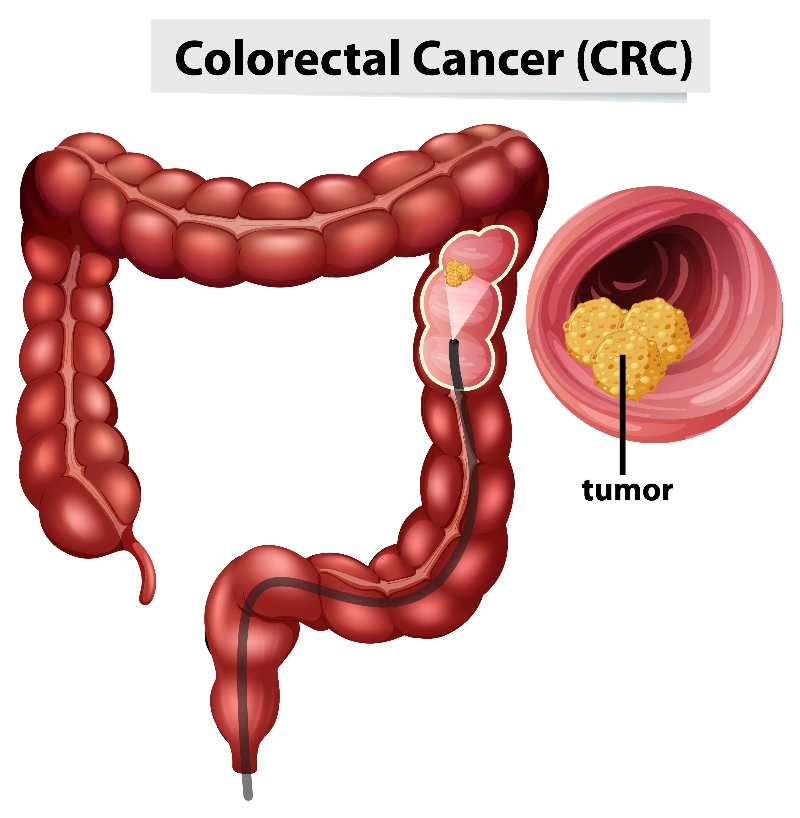 Best Clinic to do Colorectal Surgery in Pune