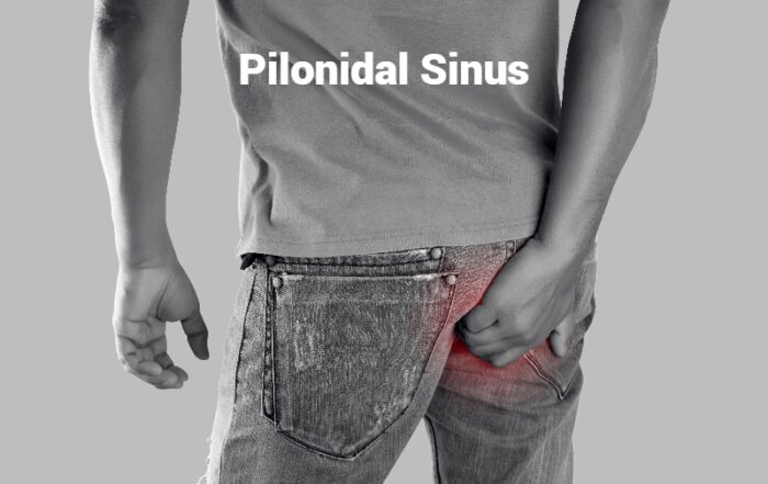 Pilonidal Sinus Infection And Surgical Treatment | Dr.Abhijit Gotkhinde