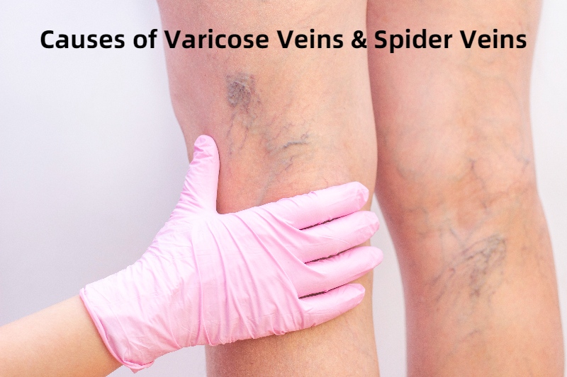 Varicose Veins Treatment in Pune
