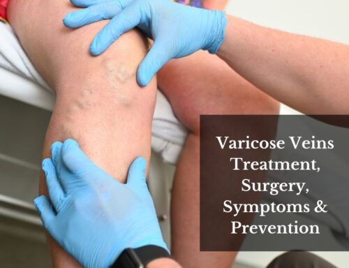 Varicose Veins Treatment, Surgery, Symptoms & Prevention