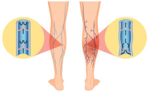 vericone veins and human leg