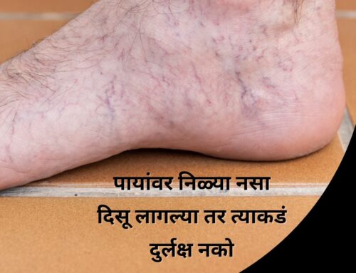 पायांवर निळ्या नसा दिसू लागल्या तर त्याकडं दुर्लक्ष नको; जाणून घ्या त्याची कारणं, लक्षणं आणि उपाय(Vericose Veins Treatment In Marathi)