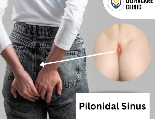Pilonidal Sinus Treatment