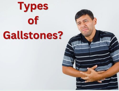 What are the 3 types of Gallstones?