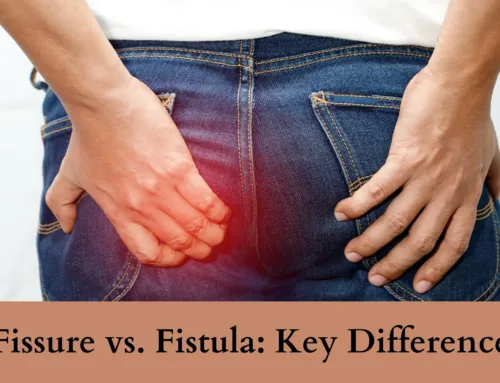 Fissure vs. Fistula: How to Differentiate and Seek the Right Treatment
