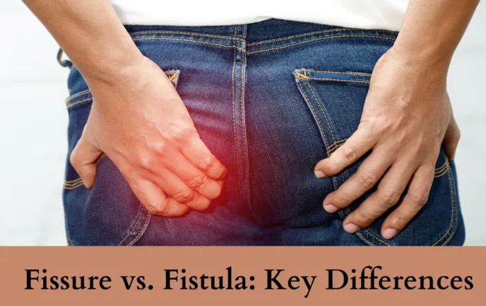Fissure vs. Fistula
