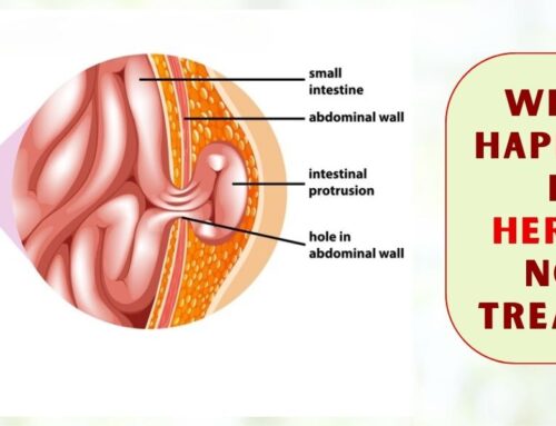 What Happens if Hernia is Not Treated?