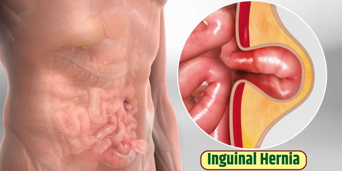 Hernia: What it is, Symptoms, Types, Causes & Treatment
